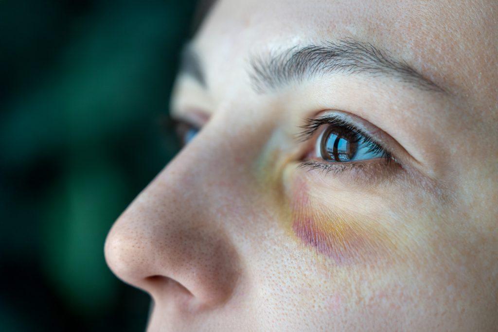 Close-up of person's face with bruising representing healing from intimate partner violence through EMDR therapy